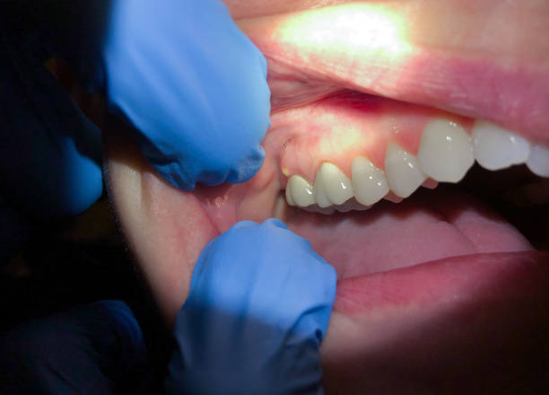 Best Emergency Denture Repair in Valley Stream, NY